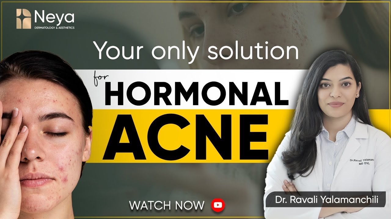 Hormonal acne treatment | Dermatologist in Hyderabad | Neya Clinic