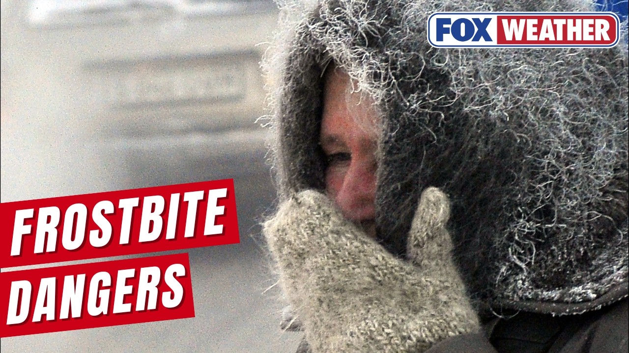 Doctor Details Dangers Of Frostbite As Extreme Cold From Arctic Air, Polar Vortex Threatens Millions