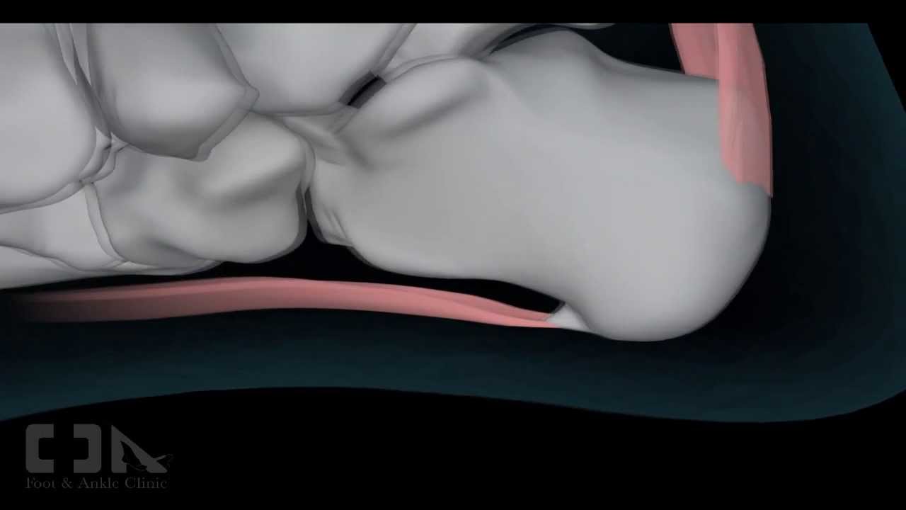 Minimally Invasive  Plantar Fasciitis / Heel Spur Surgery