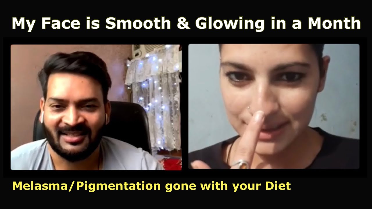 Now My Face Skin is Smooth & Glowing. Melasma/Pigmentation gone within a month with your Diet