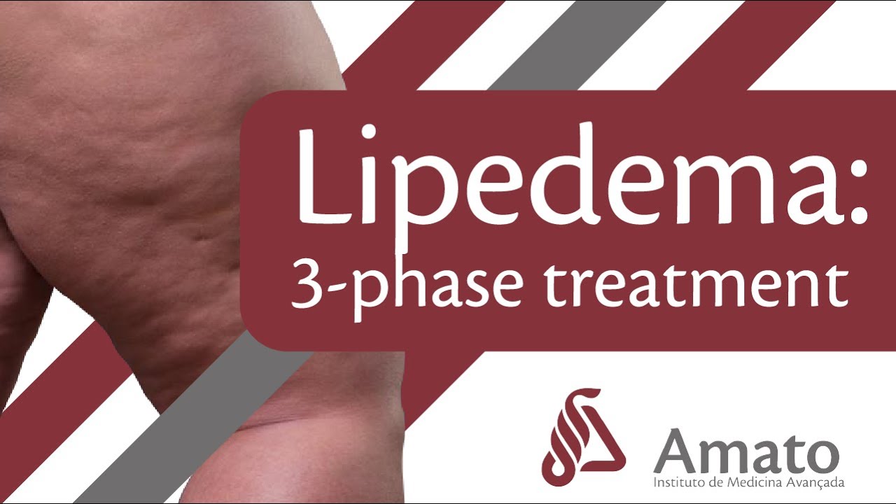 What's the SECRET to Effective Lipedema Treatment?