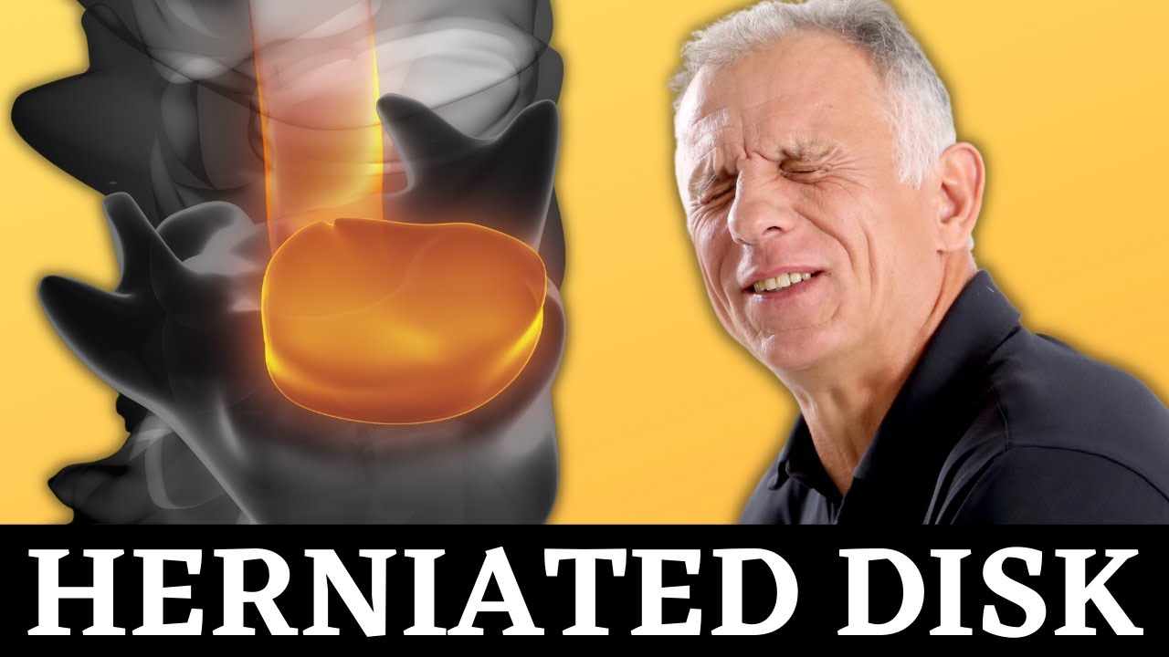 Top 3 Exercises For Herniated Disc