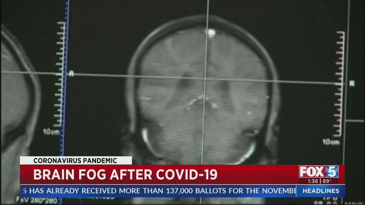 COVID-19 Patients Report Brain Fog Months After Diagnosis