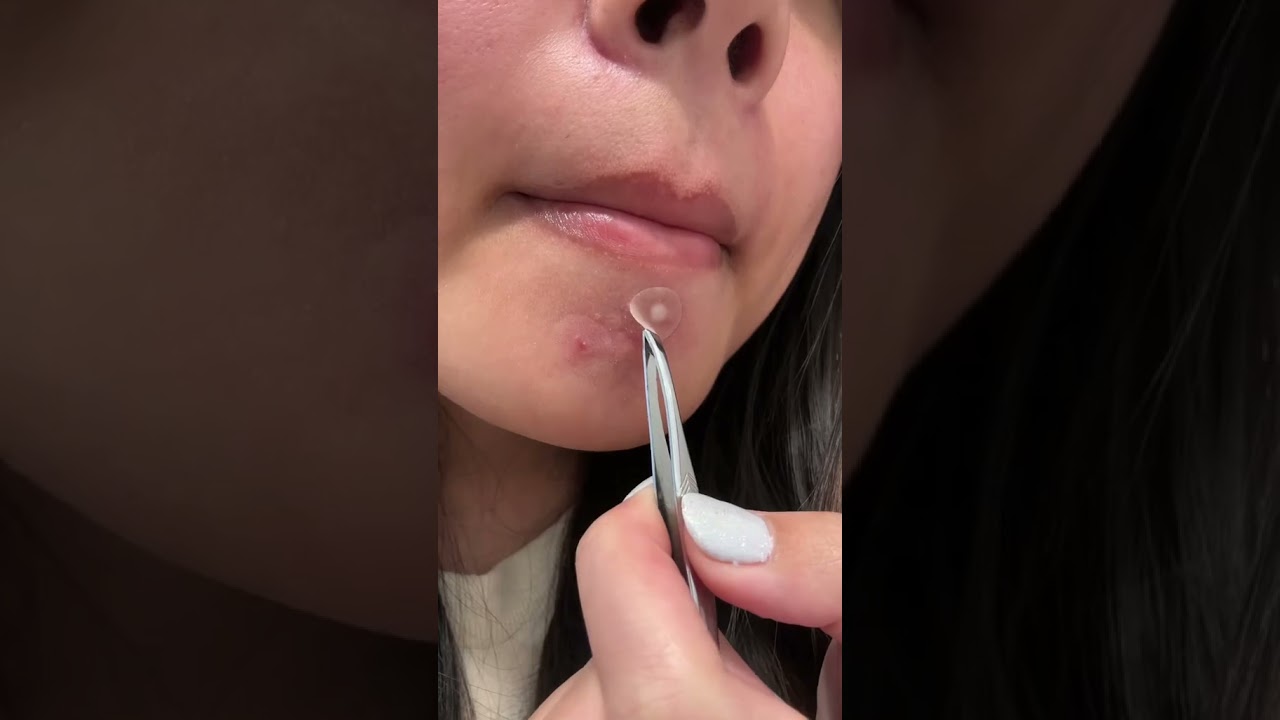 How do you flatten a pimple?! #pimplepatch #pimple #oddlysatisfying #acneproneskin #acne