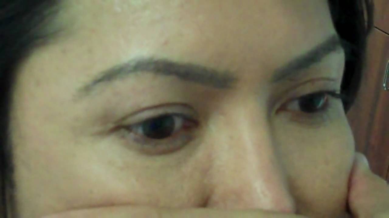 Dr. Jeffrey Epstein / Eyebrow and Eyelash Transplant / 1 yr post-operative results