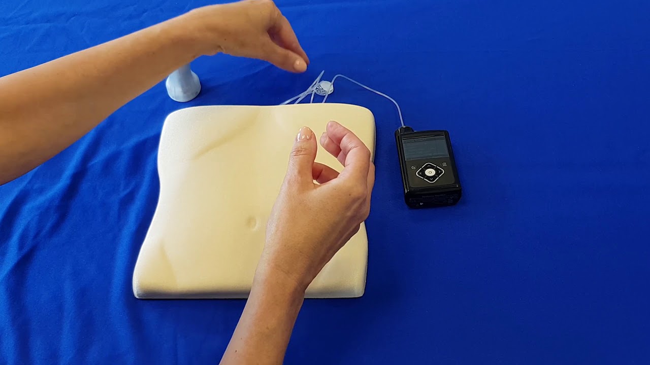 Il set di infusione MiniMed™ Mio Advance™ - Medtronic Pompa per insulina