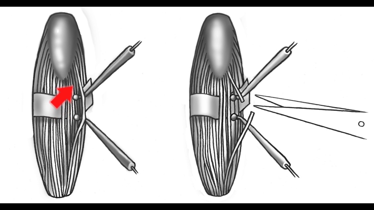 Dr. Samuel Browd discusses Selective Dorsal Rhizotomy (SDR).