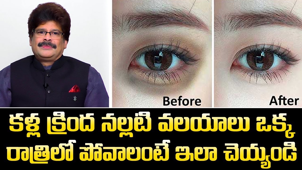 ఇలా చేస్తే కళ్ల క్రింద నల్లటి వలయాలు ఒక్క రాత్రిలో పోతాయి || Remedies For Under eye Dark Circles