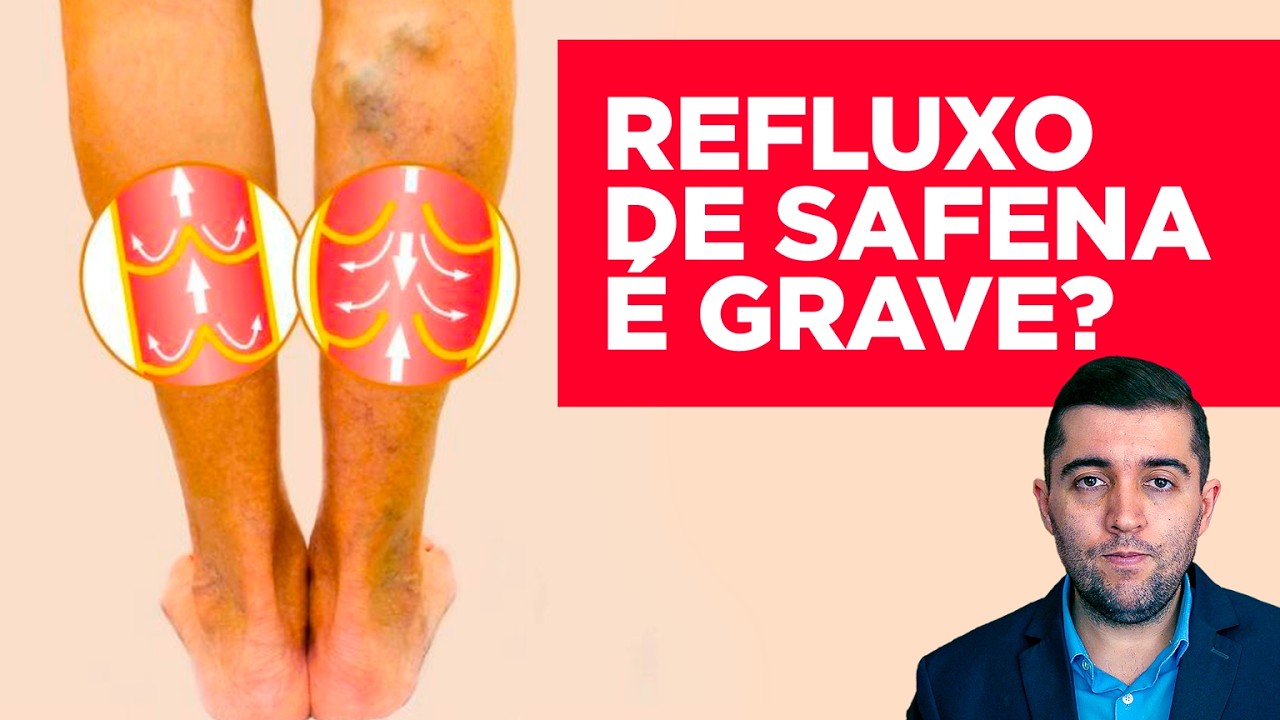 Refluxo da safena e varizes: o que é mito e o que é verdade sobre coágulos e “veia entupida”