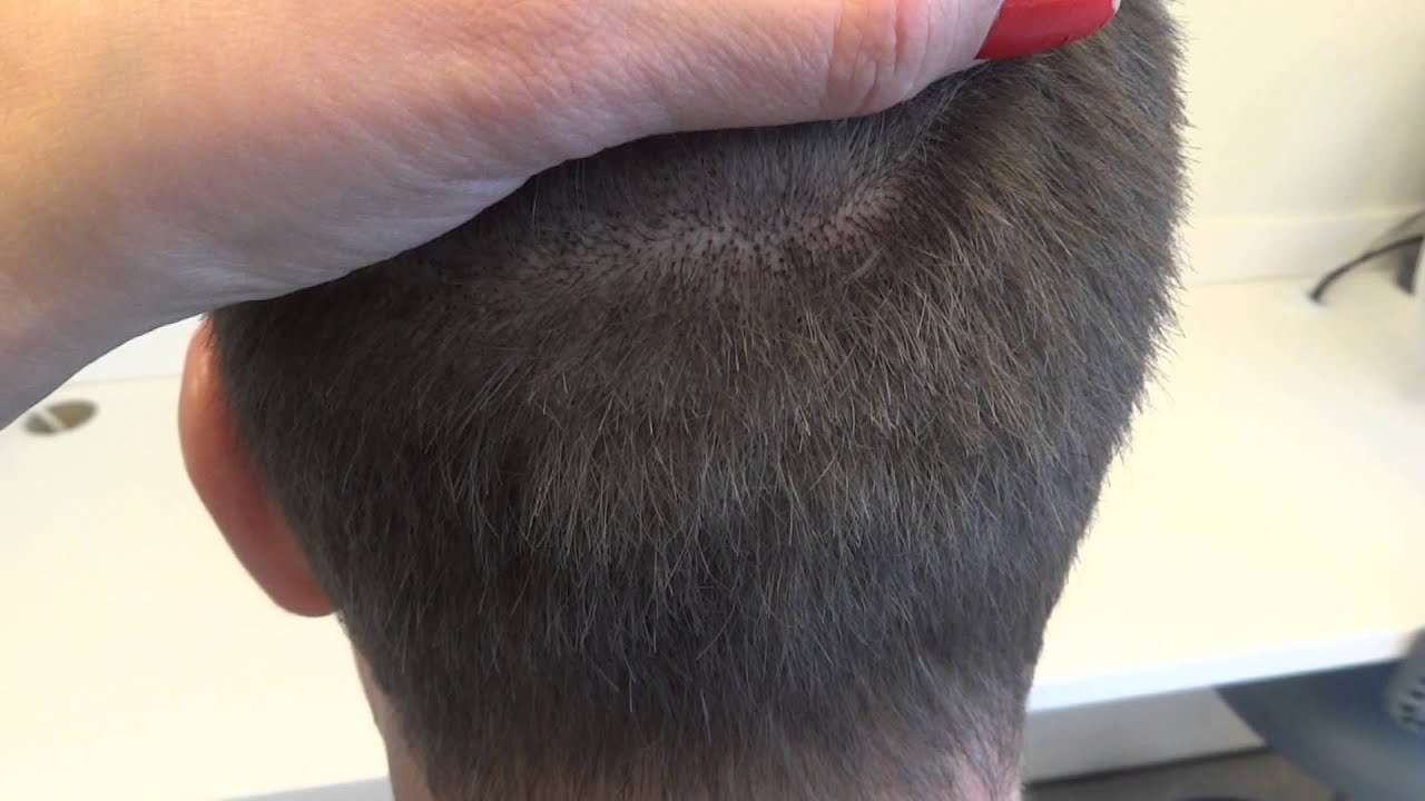 Micro pigmentation example scar enhancement