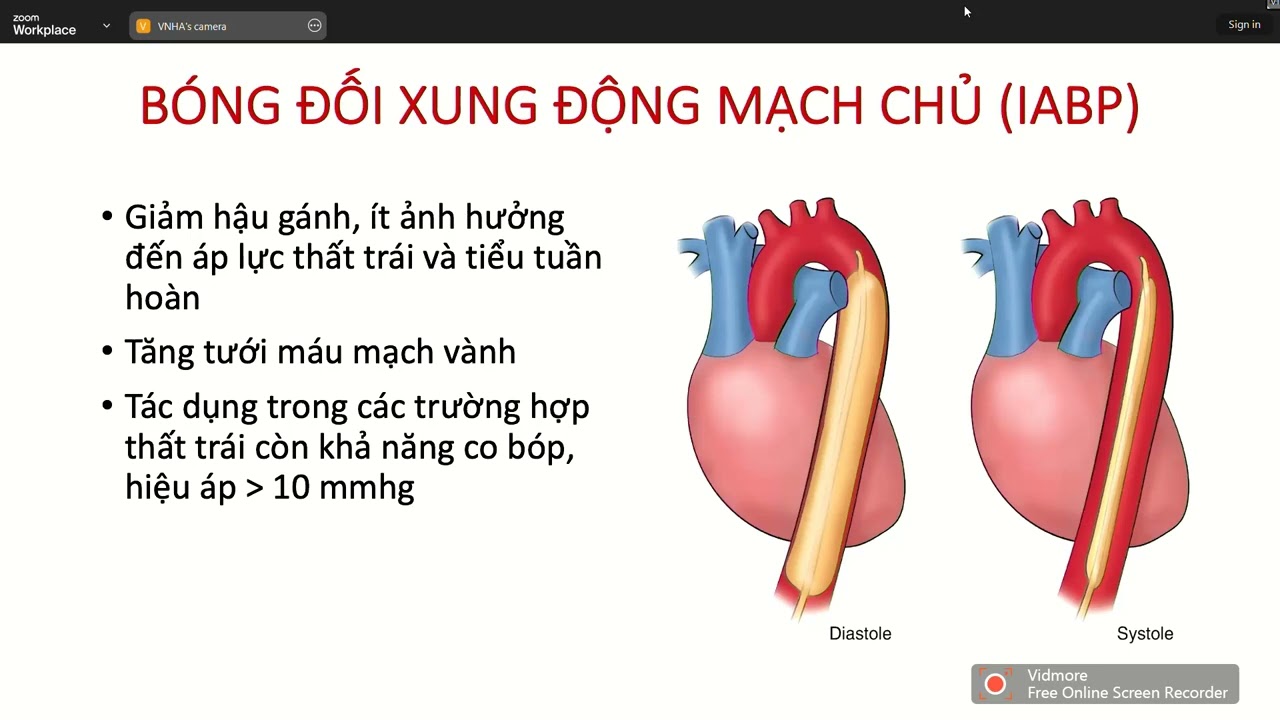GIẢM ÁP THẤT TRÁI Ở BỆNH NHÂN VA – ECMO