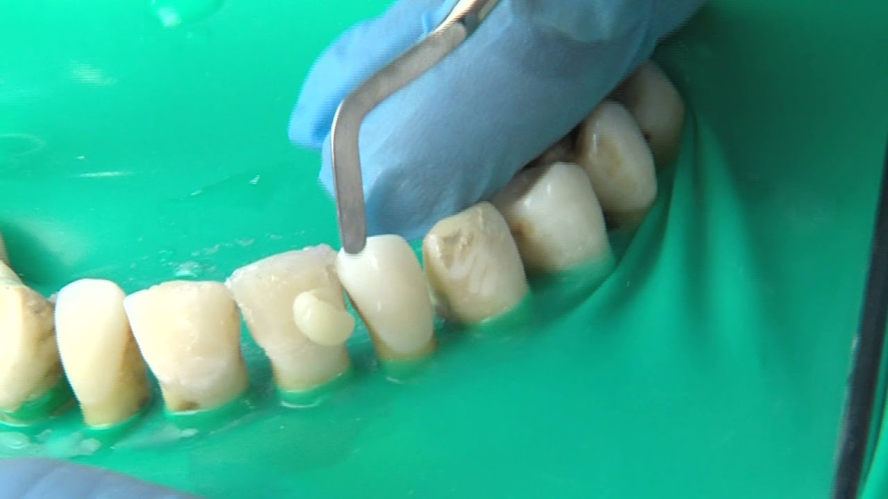 OPERATORIA DENTAL Y ENDODONCIA: TÉCNICAS Y MATERIALES_11. COMPOSITE: CAVIDAD DE CLASE IV.