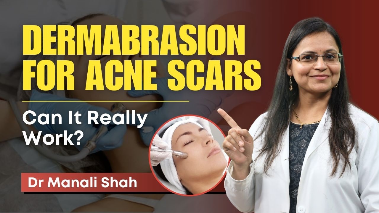 Dermabrasion: Acne Scars के लिए Effective? | Benefits, Procedure, and Results | Clear Skin, Pune