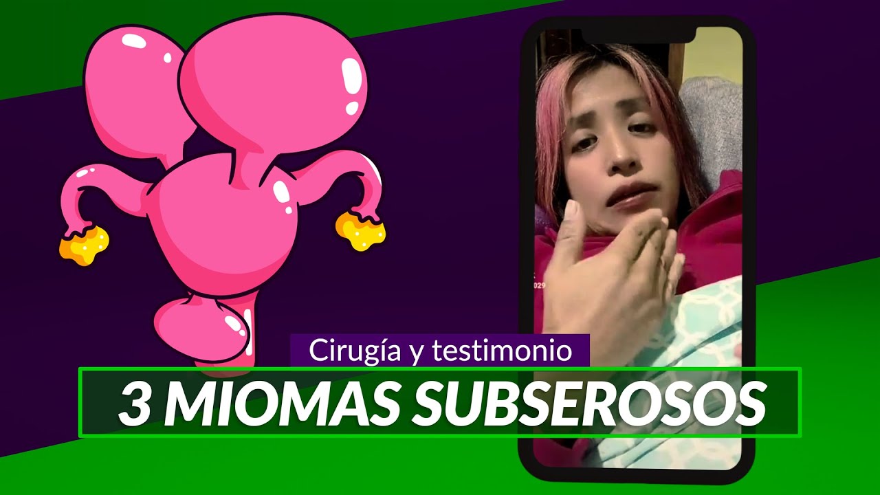 3 Miomas subserosos (Cirugía y testimonio)
