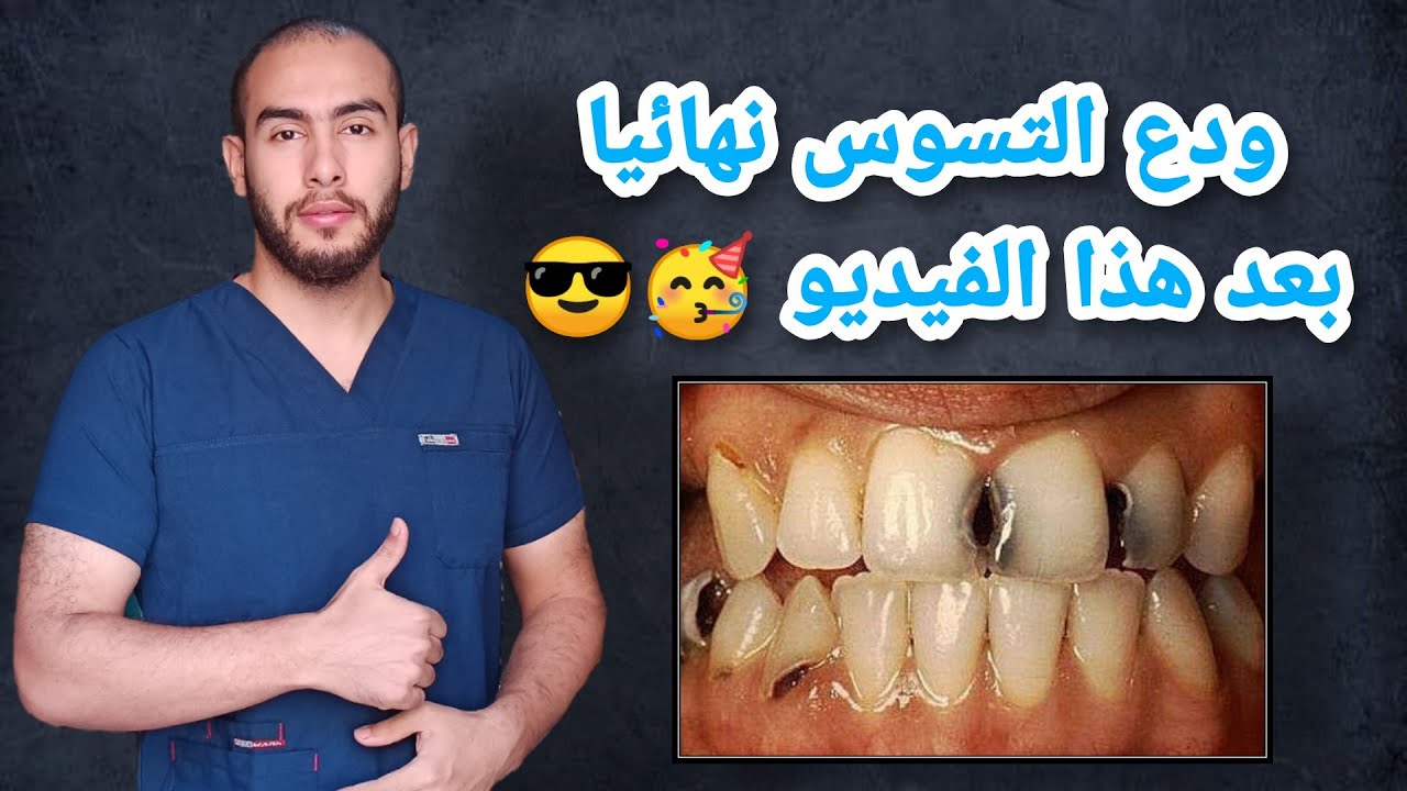 تخلص نهائيا من تسوس الاسنان بعد هذا الفيديو | تسوس الاسنان (الانواع - الأعراض - العلاج )