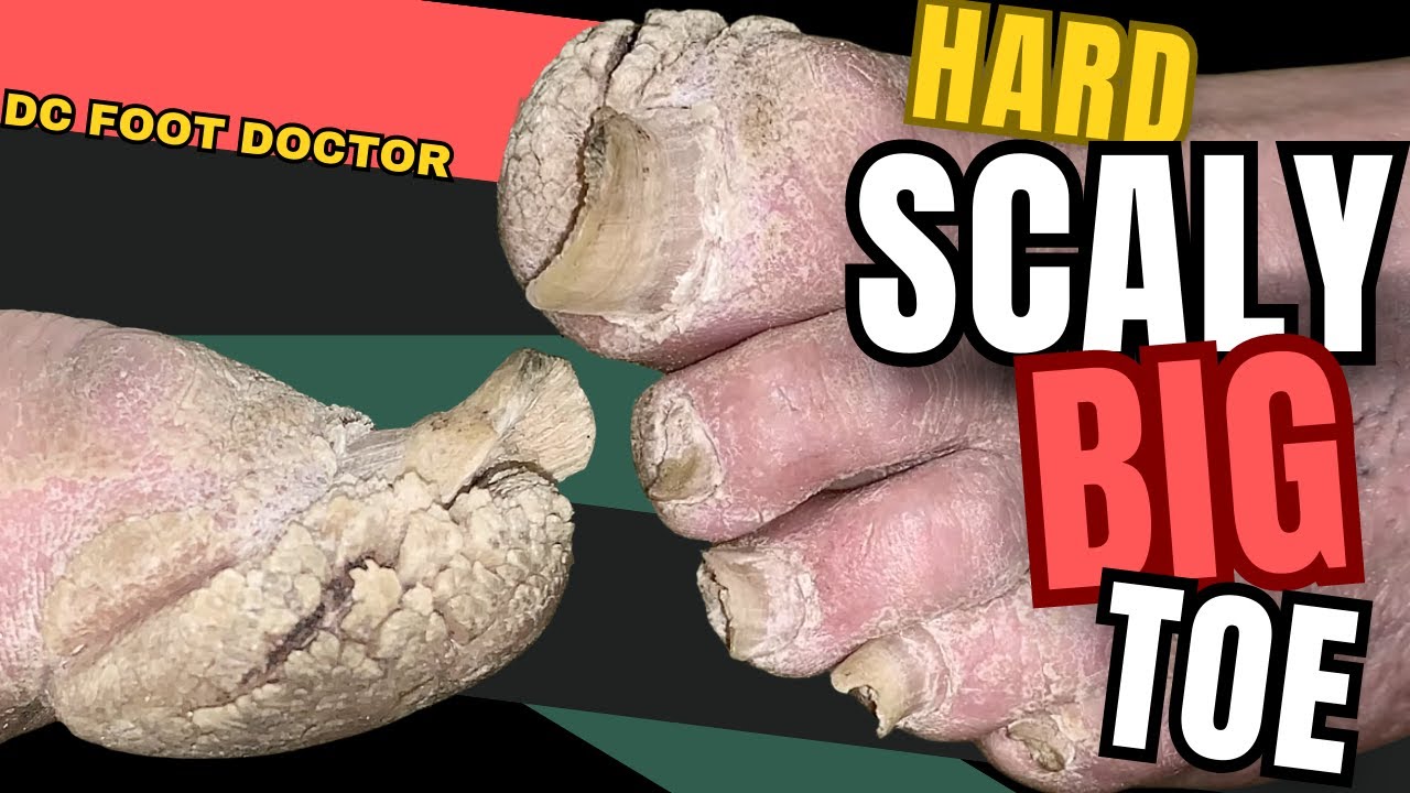 Hard Scaly Big Toe