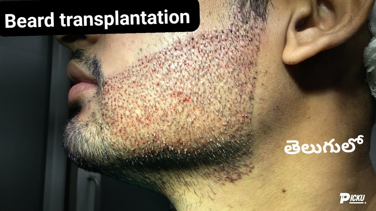 Beard transplantation telugu // telugu hair transplant