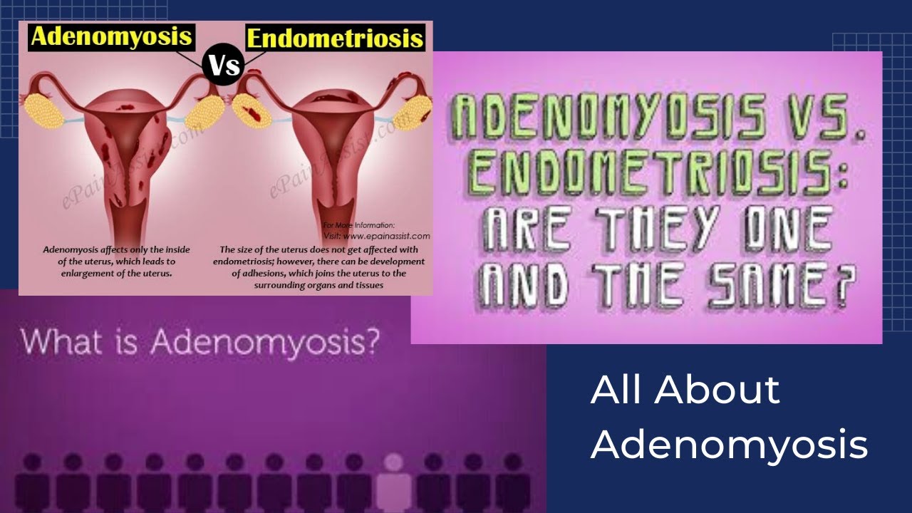 All About Adenomyosis