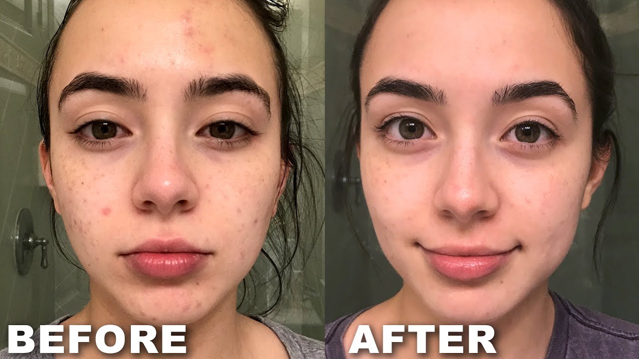 How I got rid of my ACNE and Transformed My Skin - Merrell Twins
