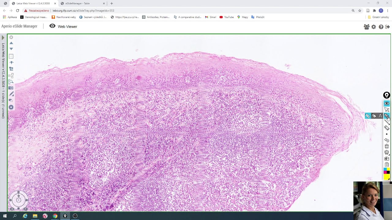 язычные миндалины