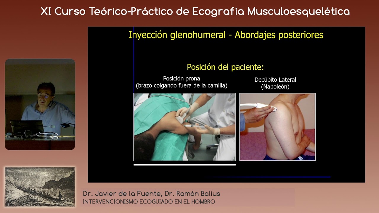 2019 Infiltraciones glenohumerales ecoguiadas en la capsulitis retráctil de hombro