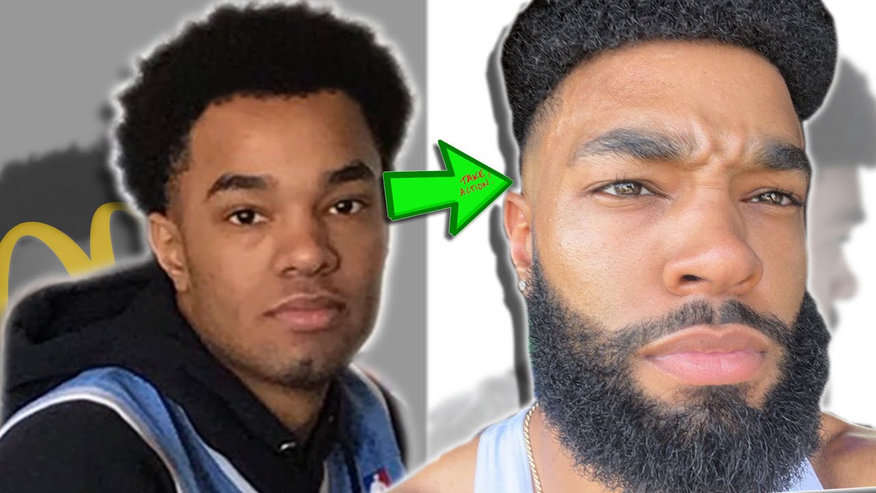 How I Reversed My Receding Hairline! (Permanently)