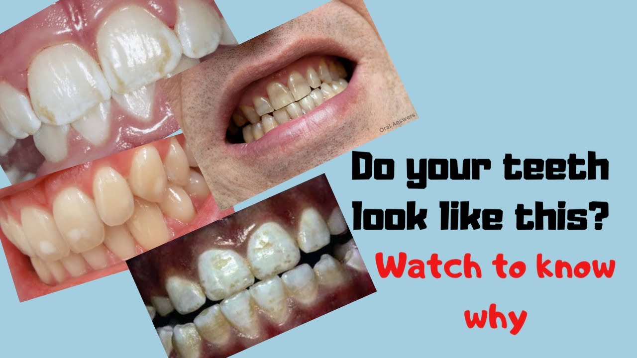 DISCOLORED TEETH?
