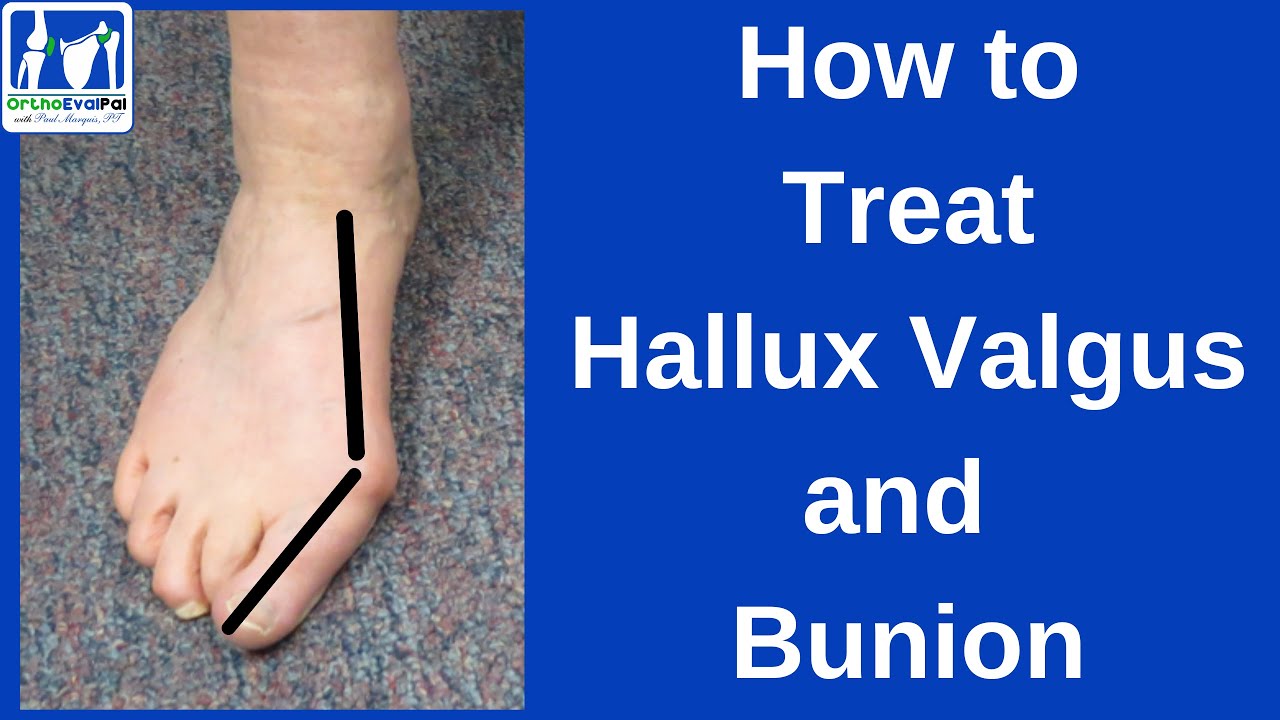 How to Treat Hallux Valgus and Bunion