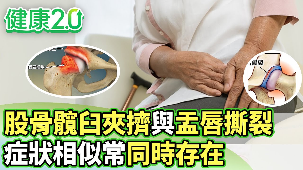 股骨髖臼夾擠與盂唇撕裂 症狀相似常同時存在【健康2.0分段】@tvbshealth20  EP3092-1 20250920 #鄭凱云#蘇宇平#陳相宏#簡文仁#芳瑜