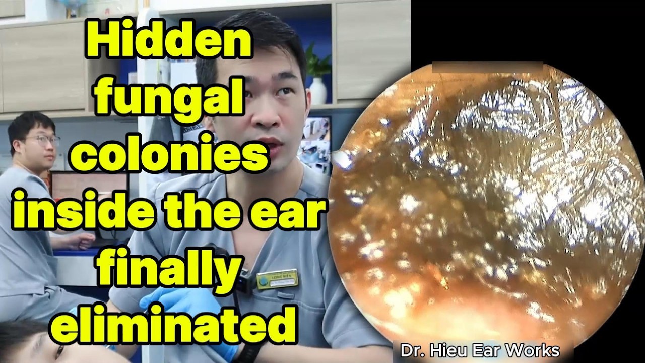 Hidden fungal colonies inside the ear finally elim | ear cleaning | ASMR earwax | soothing |relax|