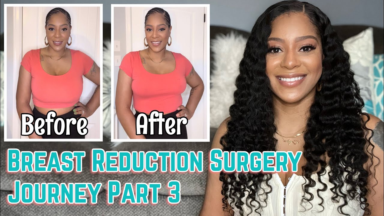 Breast Reduction Surgery Journey Part 3 | 6 Week Update | Before and After Video