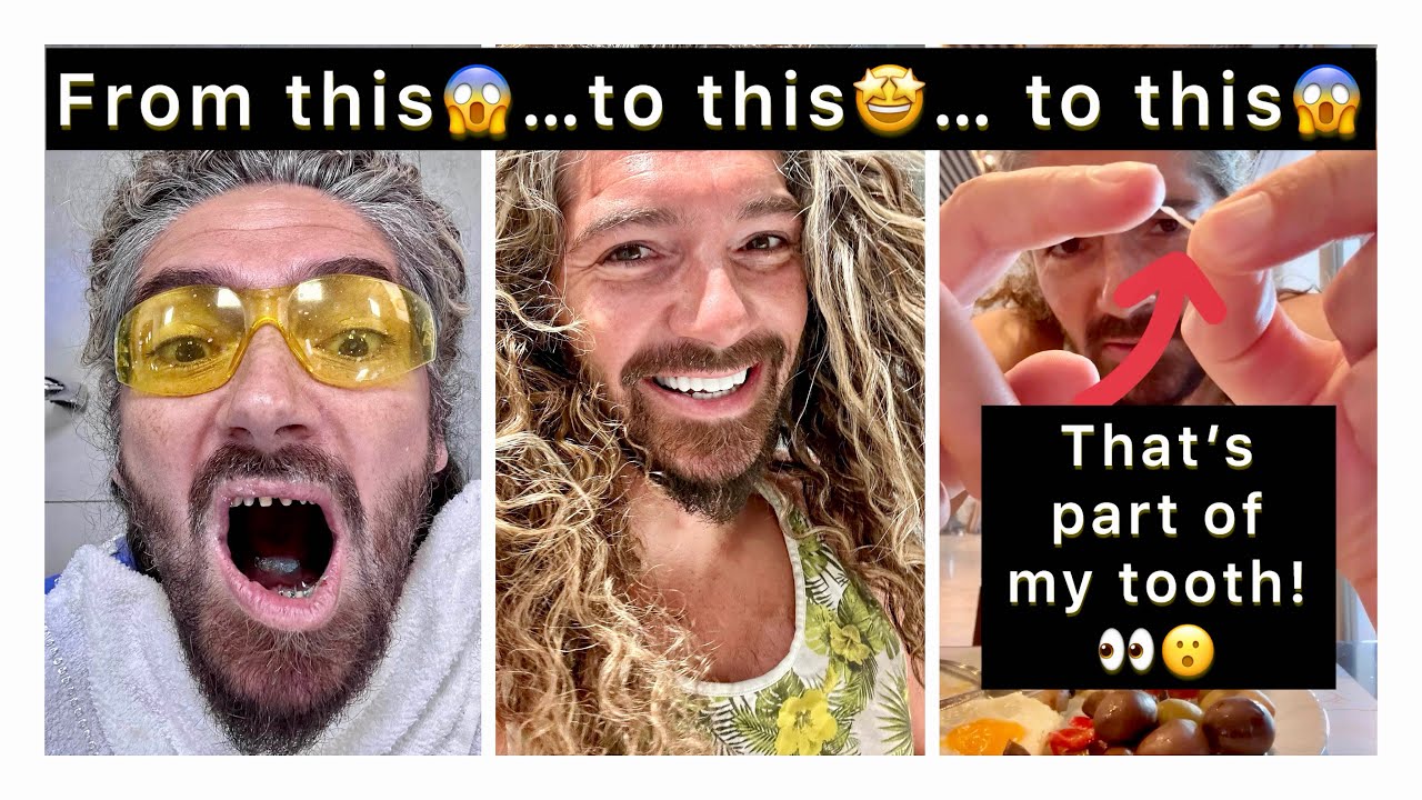 The morning after receiving these teeth in Turkey, THIS HAPPENED!😮