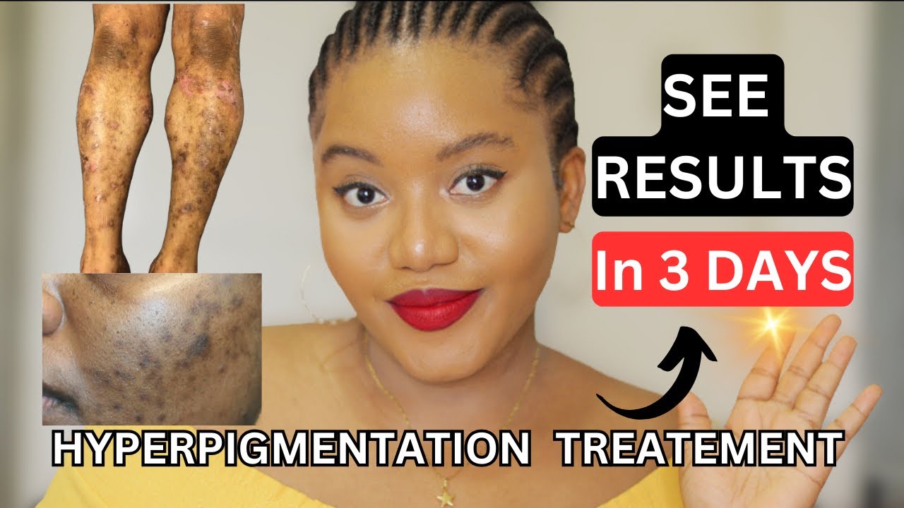 HOW TO FADE HYPERPIGMENTATION FAST 💨 | COMPLETE BODY KIT + FULL ROUTINE