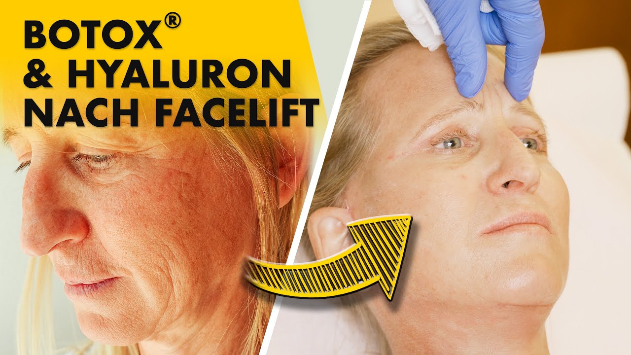 Was kann man 5 Wochen nach Fächer-Facelift noch verbessern? Botox®, Hyaluron...