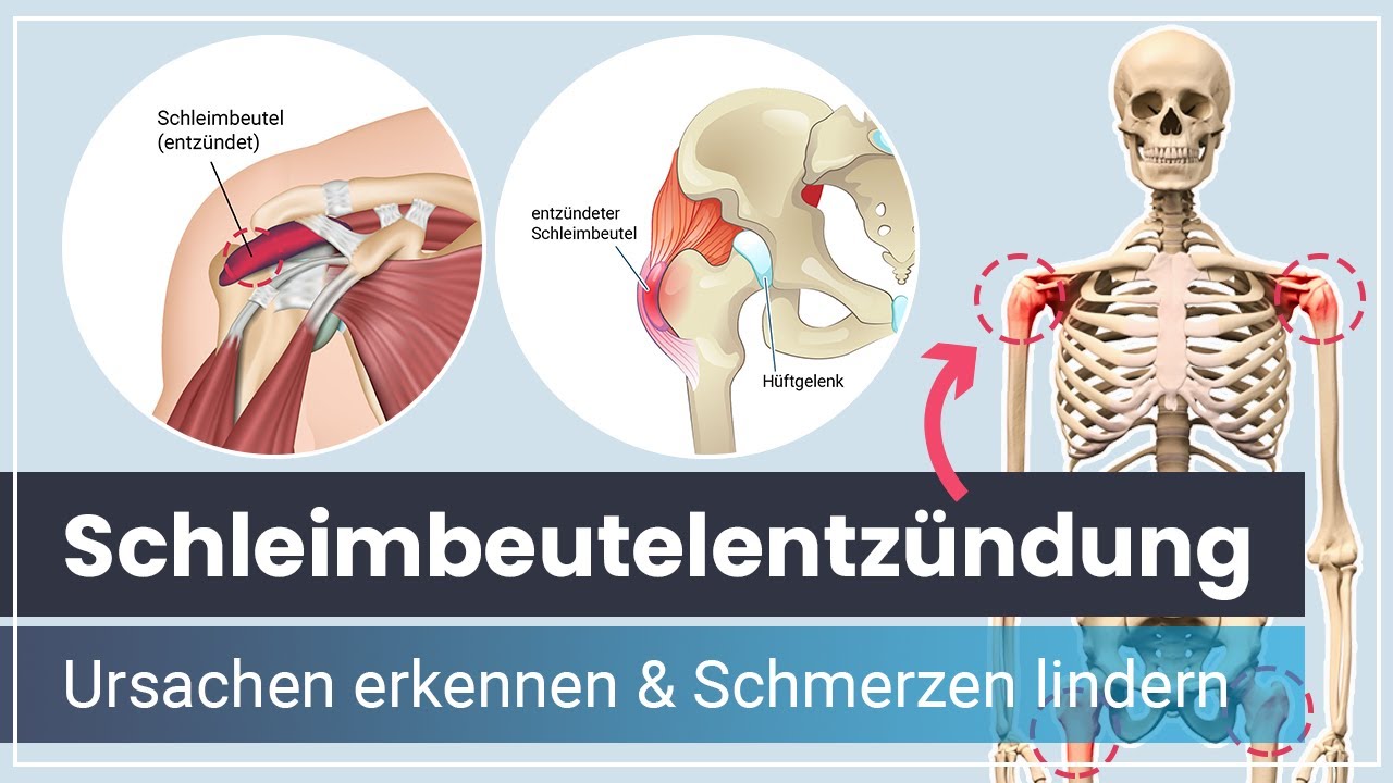 Schleimbeutelentz&uuml;ndung ➡️ Ursachen der Bursitis erkennen & Schmerzen lindern