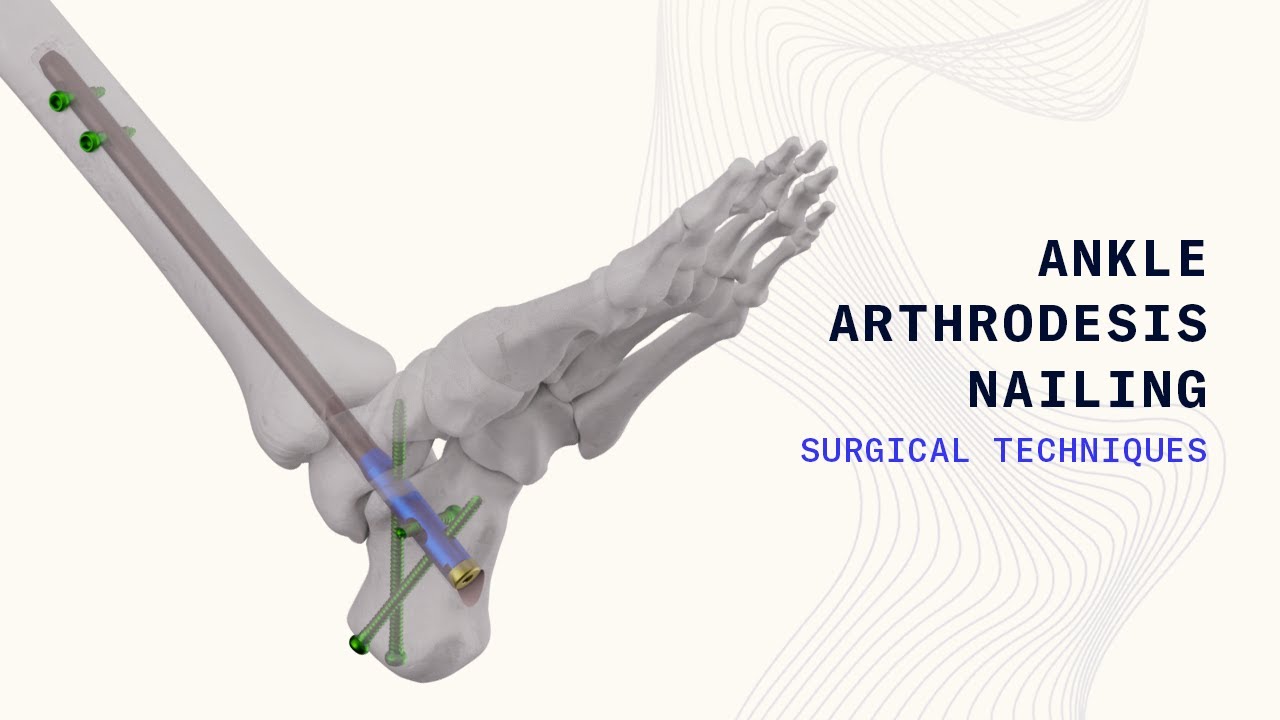 Ankle Arthrodesis Nailing System | Stable Intramedullary Fixation for Complex Ankle Fusion