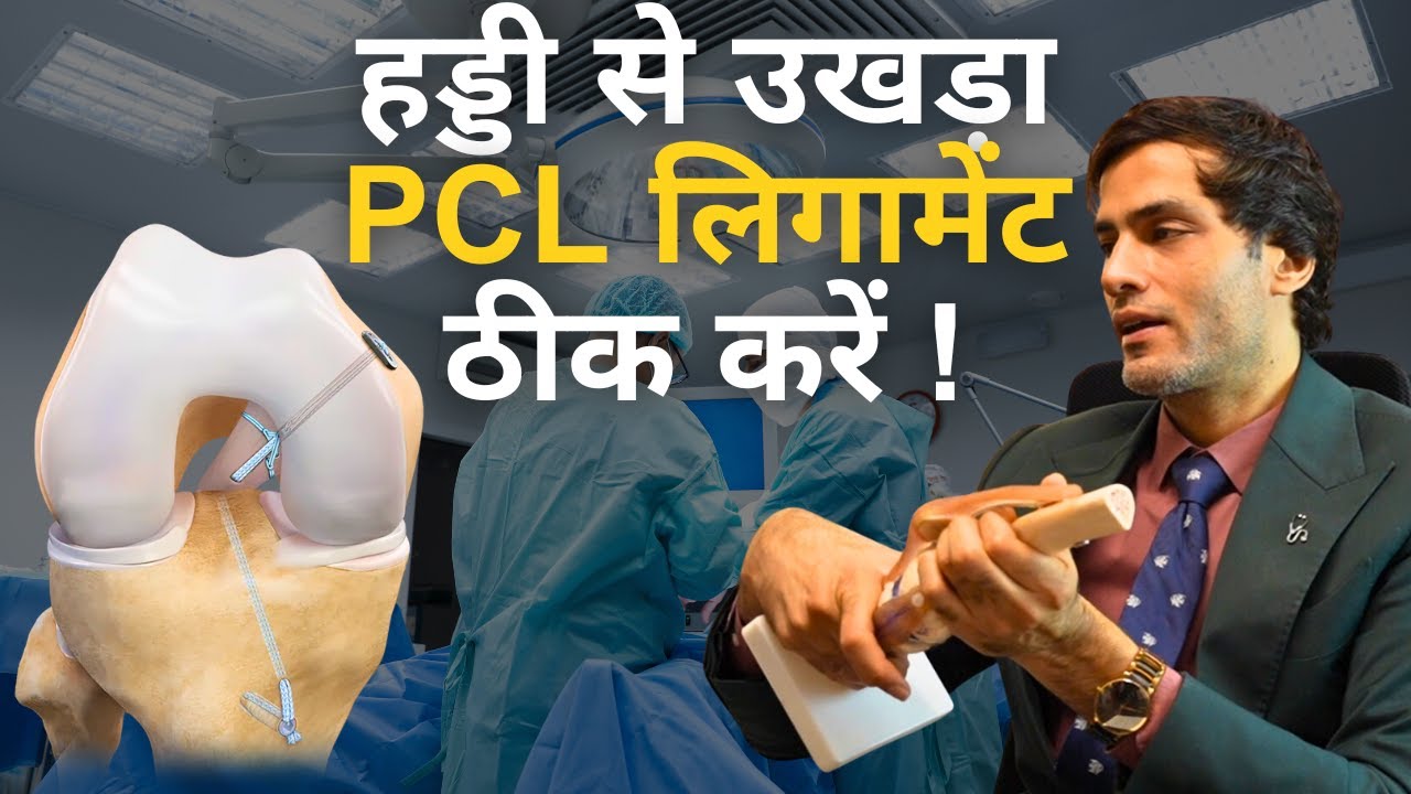 हड्डी से उखड़ा PCL लिगामेंट ठीक करें ! PCL Ligament Tibial Spine Avulsion Fracture Best Treatment