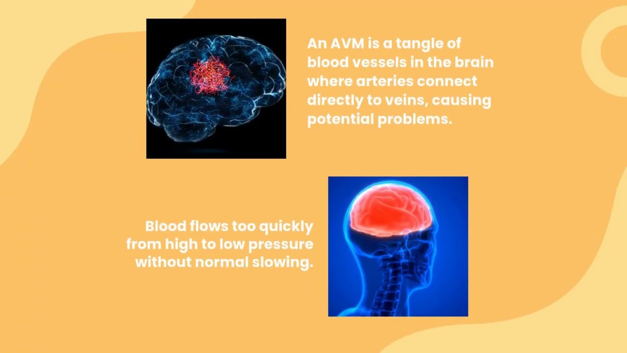 Arteriovenous Malformation (AVM) An Arteriovenous Malformation (AVM) in the brain is a congenital...