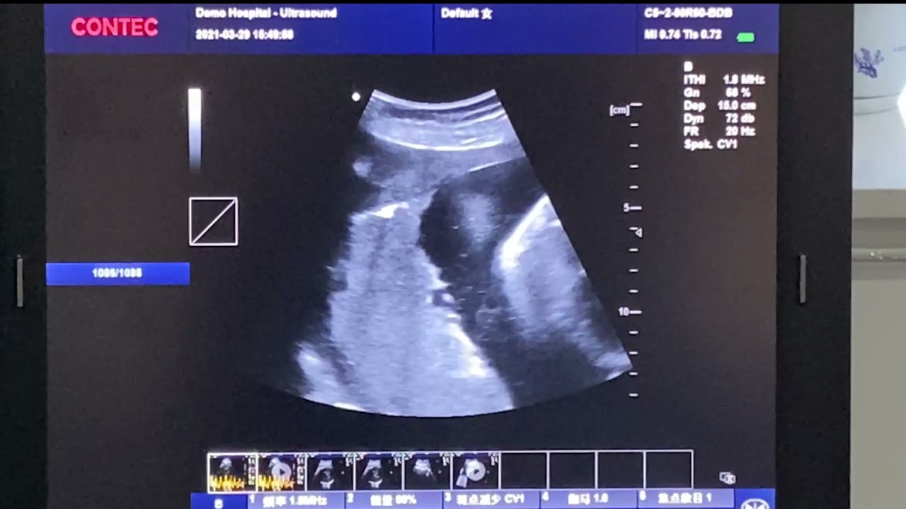 CONTEC CMS1700B Color Doppler Ultrasound Diagnostic System Clinic Examination