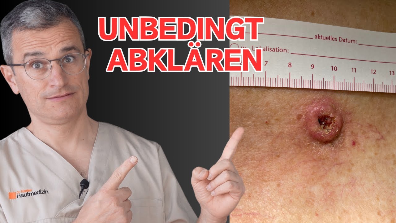 Keratoakanthom: Was Sie über diesen Hauttumor wissen müssen! | Dr. Kasten Hautmedizin