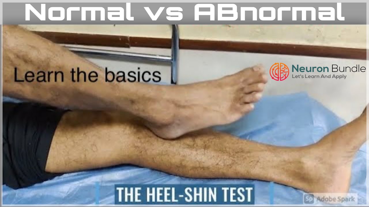 Heel to Shin TEST #coordinationtest #Normal #Abnormal #assessment #procedure  #cerebellum #neurology