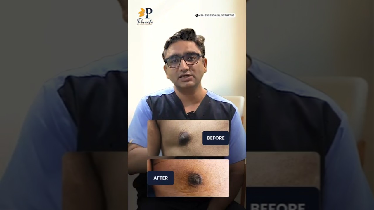 Male Nipple Reduction | Before After Results | Hide Visible Nipples on Your Shirt
