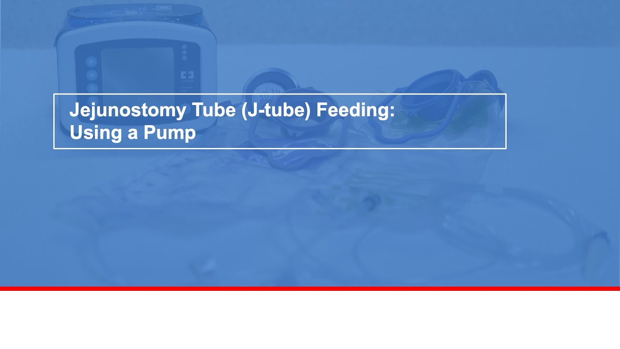 Jejunostomy tube (J-tube) feeding: Using a pump