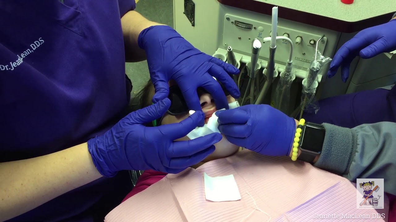 Etch + MI Paste Minimally Invasive Dentistry Protocol for White Spot Lesions and Enamel Defects