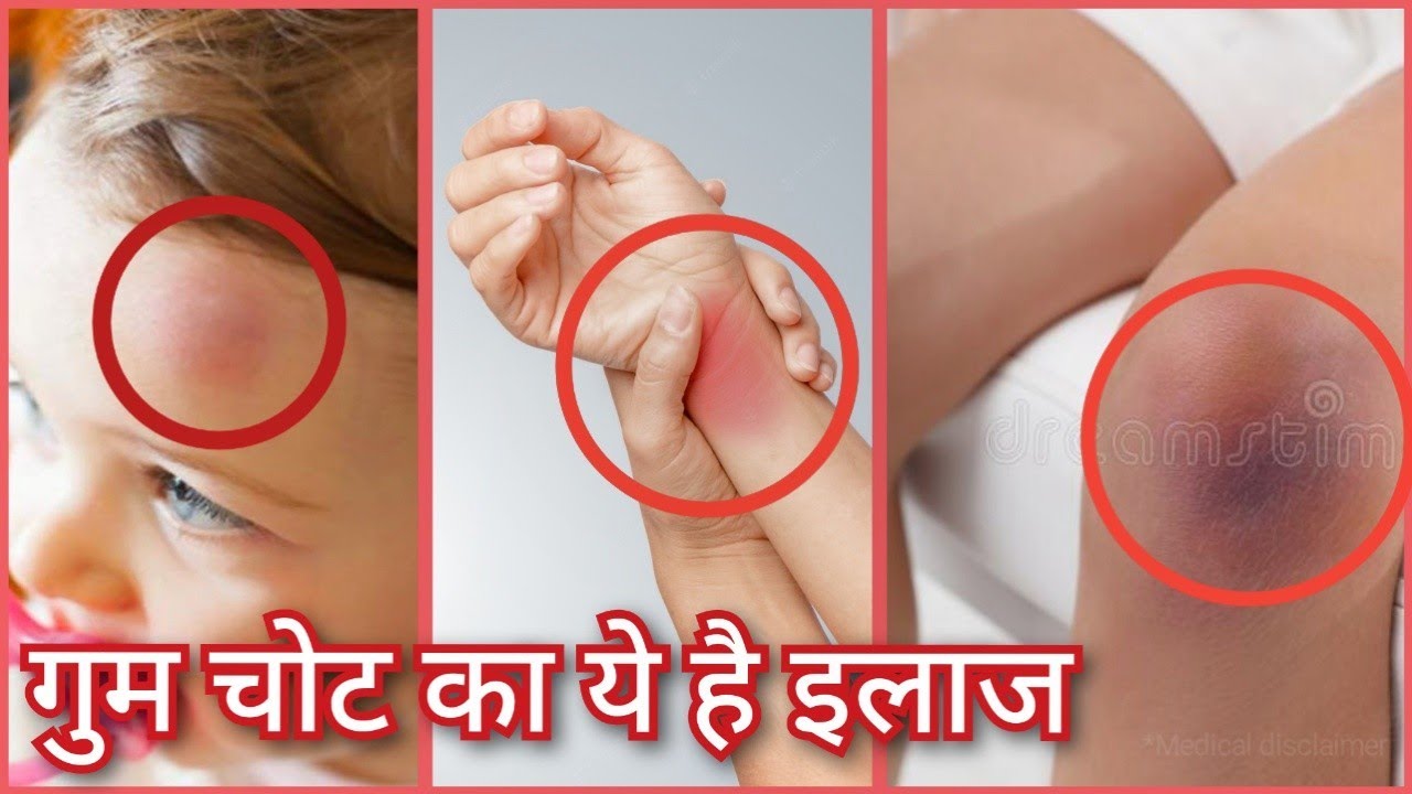 गुम चोट को जड़ से खींच लेगा ये उपचार | Muscle Tenderness Cure