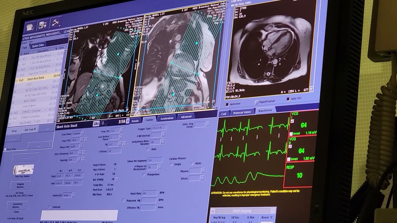 Cardiac MRI performed with a co-worker. Posted with permission from the pt.
