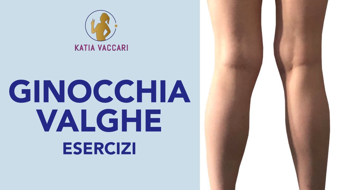 GINOCCHIA VALGHE: 2 esercizi per raddrizzarle