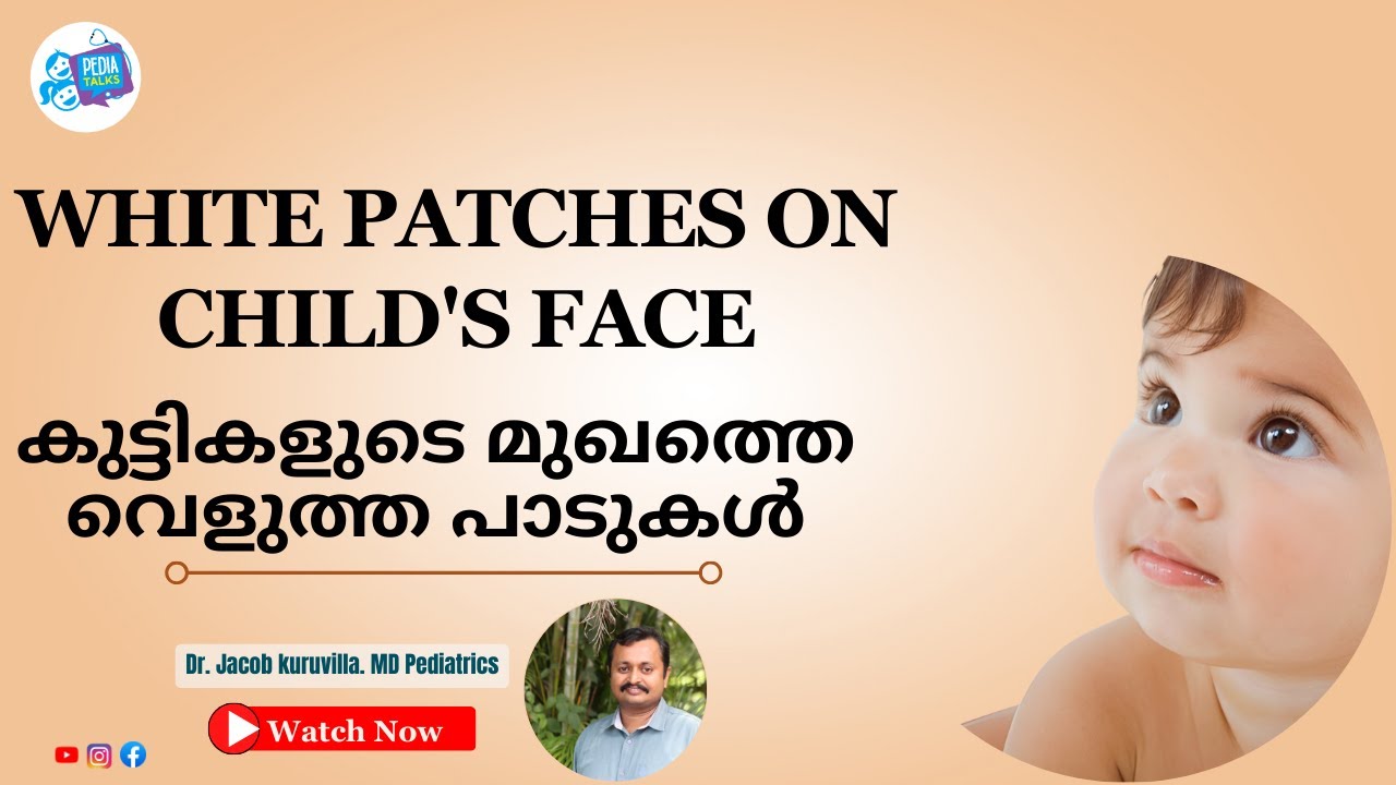 WHITE SPOTS ON CHILDREN'S FACE | കുട്ടികളുടെ മുഖത്തെ വെളുത്ത പാടുകൾ | @PediaTalks-jg4nn