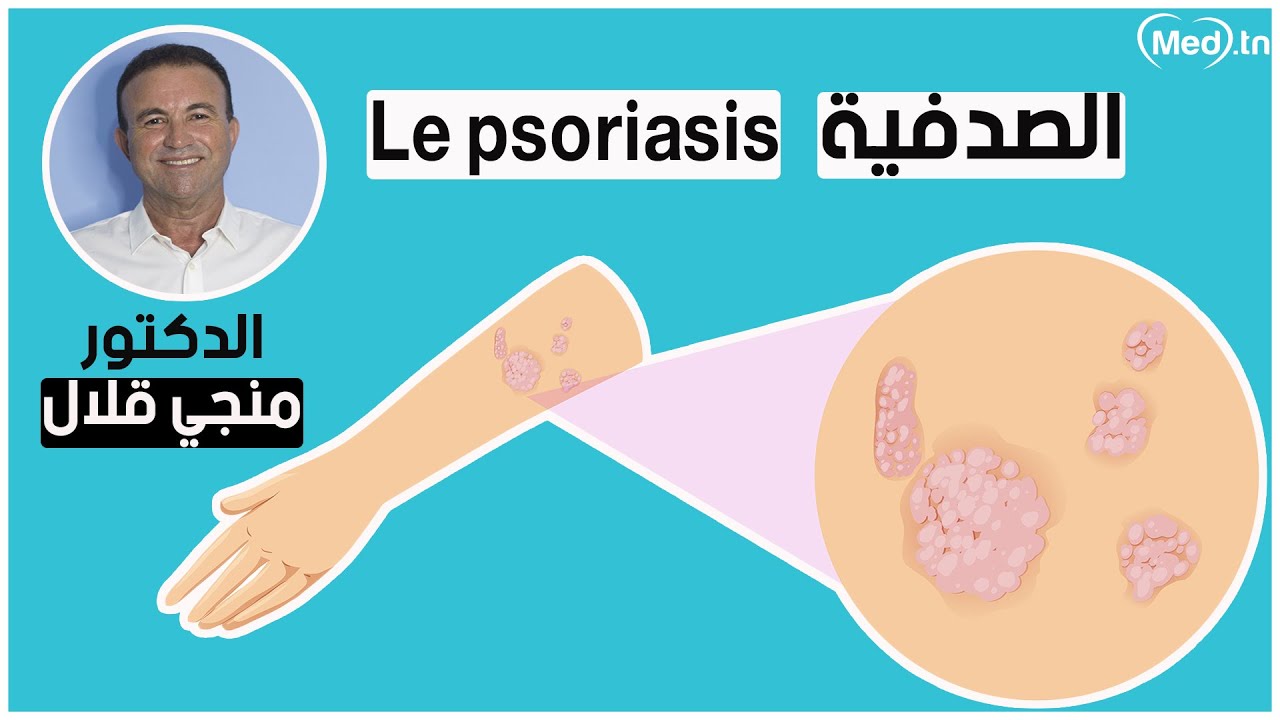 الصدفية |  الدكتور منجي قلال