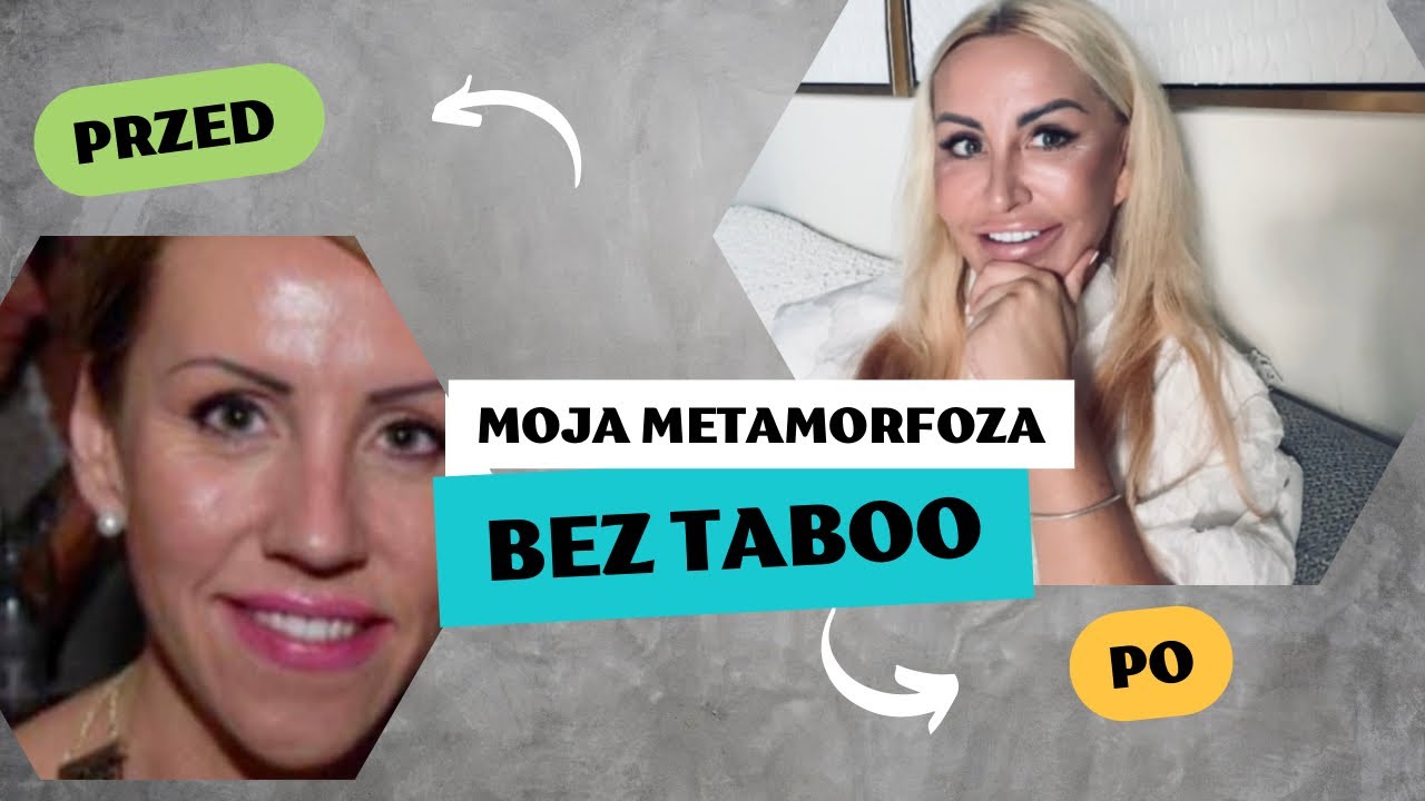 Nowa twarz 😱 Operacja, kt&oacute;ra zmieniła moje życie&hellip; progenia i usta 😱😱😱